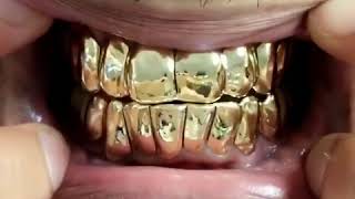 14k Solid Gold Grillz | Buy 10k, 14k, 18k Gold Grillz | Laviticus #Dallas #Houston #Texas