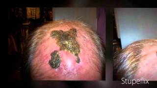 Hans Wiemann / PAI Medical hair transplant results