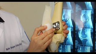 Surgery for Patellofemoral Arthritis by Dr. Shubin Stein