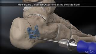 Medializing Calcaneal Osteotomy using the Step Plate™