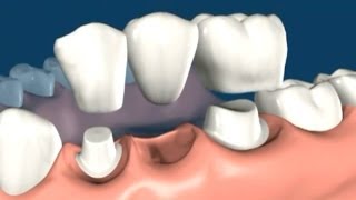 Fogpótlás híddal - MindentMent® Fogászat