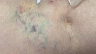 varicose vein treatment with foam sclerotherapy