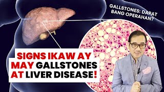 3 Signs na may FATTY LIVER at GALLSTONES ka! Dapat bang operahan? | DR TONY LEACHON