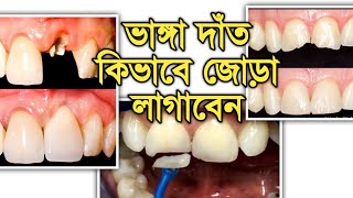 ভাঙ্গা দাঁতের চিকিৎসা কিভাবে করবেন@DentalHealthTips