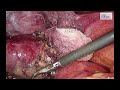 how i do it safe lc in gangrenous cholecystitis in cirrhotic patient ss inner layer theory