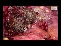 how i do it safe lc in gangrenous cholecystitis in cirrhotic patient ss inner layer theory