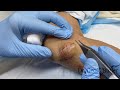 Removal of a fairly large epidermal cyst on the elbow