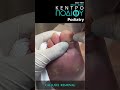 toe calluses removal callus κεντροποδιου kentropodiou podiatry podiatria podologia podiatrist