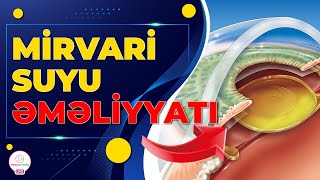 MİRVARİ SUYU ƏMƏLİYYATI NECƏ HƏYATA KEÇİRİLİR / OFTALMOLOQ CAHİD ŞAHBAZOV