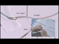 angioplasty technique rotablator 1