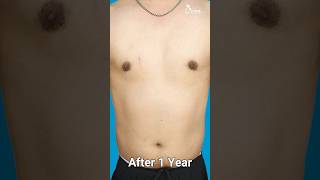 Gynecomastia Surgery Result! Grade 3A Treatment with 360 4dx Technique #shortsfeed