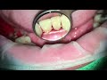 severe tartar deposition and gum swelling