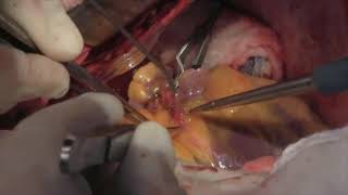 Coronary Artery Bypass Surgery: Internal Mammary Arteries (Graphic)