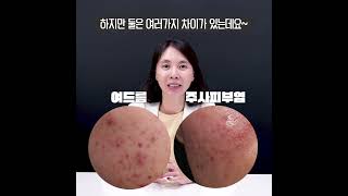 주사피부염 vs 여드름 어떻게 구분하지?? #shorts