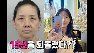 안면거상 목거상 100% 리얼 후기, 57세 맞으신가요??