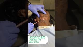 Advanced GFC Treatment for Burn Scars | Anew Aesthetic Clinic | Bangalore, Goa and Maldives