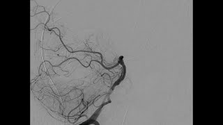 A Spontaneous Basilar Artery Dissection With an Intimal Flap Imaged With Several Techniques