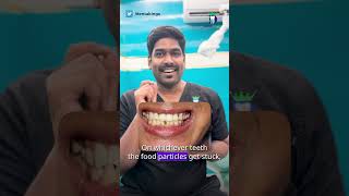 எந்த பல்லில் சொத்தை வாய்ப்பு உள்ளது - How to prevent proximal caries | Dr.karthikeyan | Denta Kings