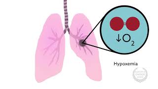 How Anesthesiologists Can Help With Transfusion related Acute Lung Injury