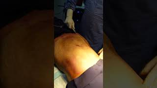 360 Abdominal Liposuction | Liposuction cost