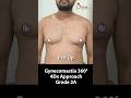 Grade 2A Gynecomastia 360° Surgery Result | Male Breast Reduction Before-After #shorts