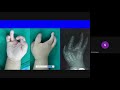 Plastiquest Case Discussion-Cleft Hand and Clinodactyly