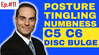 Ep11.  C5 C6 Disc Bulge, Posture, & Arm Tingling Numbness | Ask Dr. Walter Salubro
