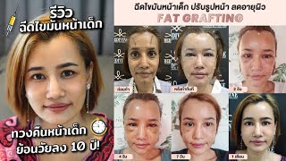 รีวิวฉีดไขมัน บอกลาความแก่ ปรับรูปหน้าสวย ด้วยการเติมไขมันหน้าเด็ก ไม่ต้องย้อนเวลา ก็หน้าเด็กลงได้!