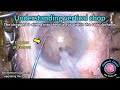 CataractCoach™ 2104: understanding vertical chop cataract surgery