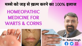 मस्से को जड़ से ख़त्म करने का 100% इलाज | Homeopathic Treatment of Warts | Evidence Based Results |