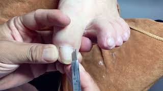 PEDICURE TRANSFORMATION  EP—038 | ASMR |Toenail Cleaning and Cutting|