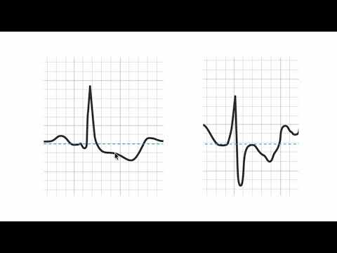 How to tell if a stress ECG (EKG) is positive? How to tell if a stress ECG (EKG) is positive?