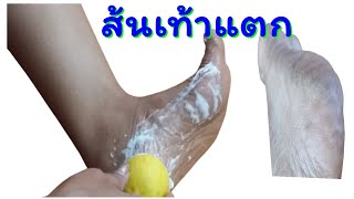 เท้าแตก  🦶  รักษาง่ายมาก | แค่ใช้ 2 สิ่งนี้  ครั้งเดียวเห็นผลทันที