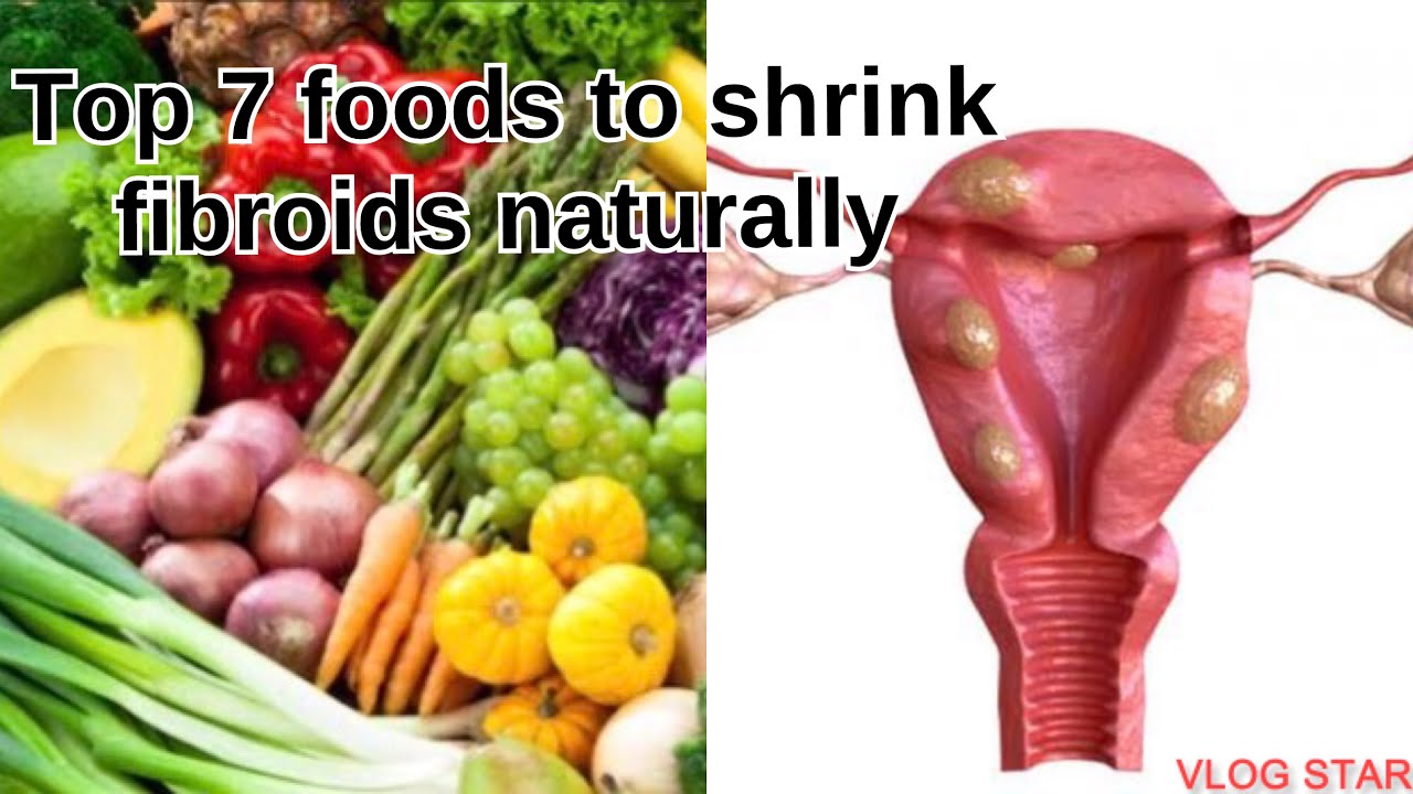 The Best Foods To Shrink Fibroids (Naturally) | Fibroid Shrinking Foods ...