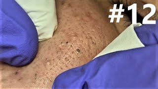 BLACKHEADS EXTRACTIONS on Happy #12