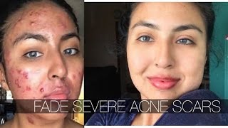 ONE PRODUCT TO FADE SEVERE CYSTIC ACNE SCARS