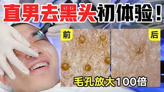 直男清理黑头初体验！