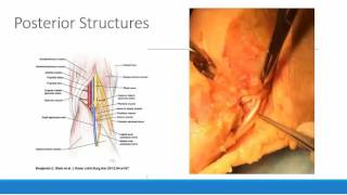 Peri-Articular Multimodal Drug Injections (PMDI)