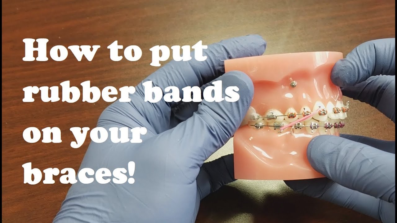 Tutorial: How To Put Rubber Bands On Your Braces - YouTube