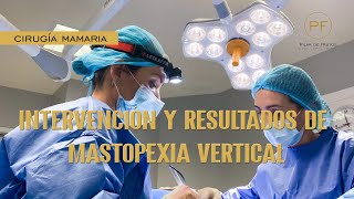 MASTOPEXIA VERTICAL : INTERVENCIÓN Y RESULTADOS