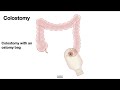 HCC 1475 10h  Surgical Anatomy Colostomy