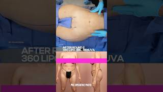 Incredible 360 Lipo & BBL Results: Dr. Rahal's Amazing Transformation!