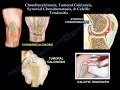 Chondrocalcinosis, Tumoral Calcinosis, synovial chondromatosis and calcific tendonitis