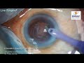 live surgery from nandadeep eye hospital dr sourabh patwardhan