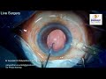 live surgery from nandadeep eye hospital dr sourabh patwardhan