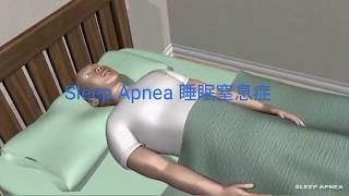 【睡眠窒息症：觀察維生指數❤愛護理✅】《Sleep Apnea: vital signs observation ❤ iLoveCare ✅》💖愛護理 💖 醫生 💖 護士 💖 醫療 💖 護理