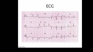 04 EKG WPW case | ករណីសិក្សារ ECG លើអ្នកជំងឺ​WPW