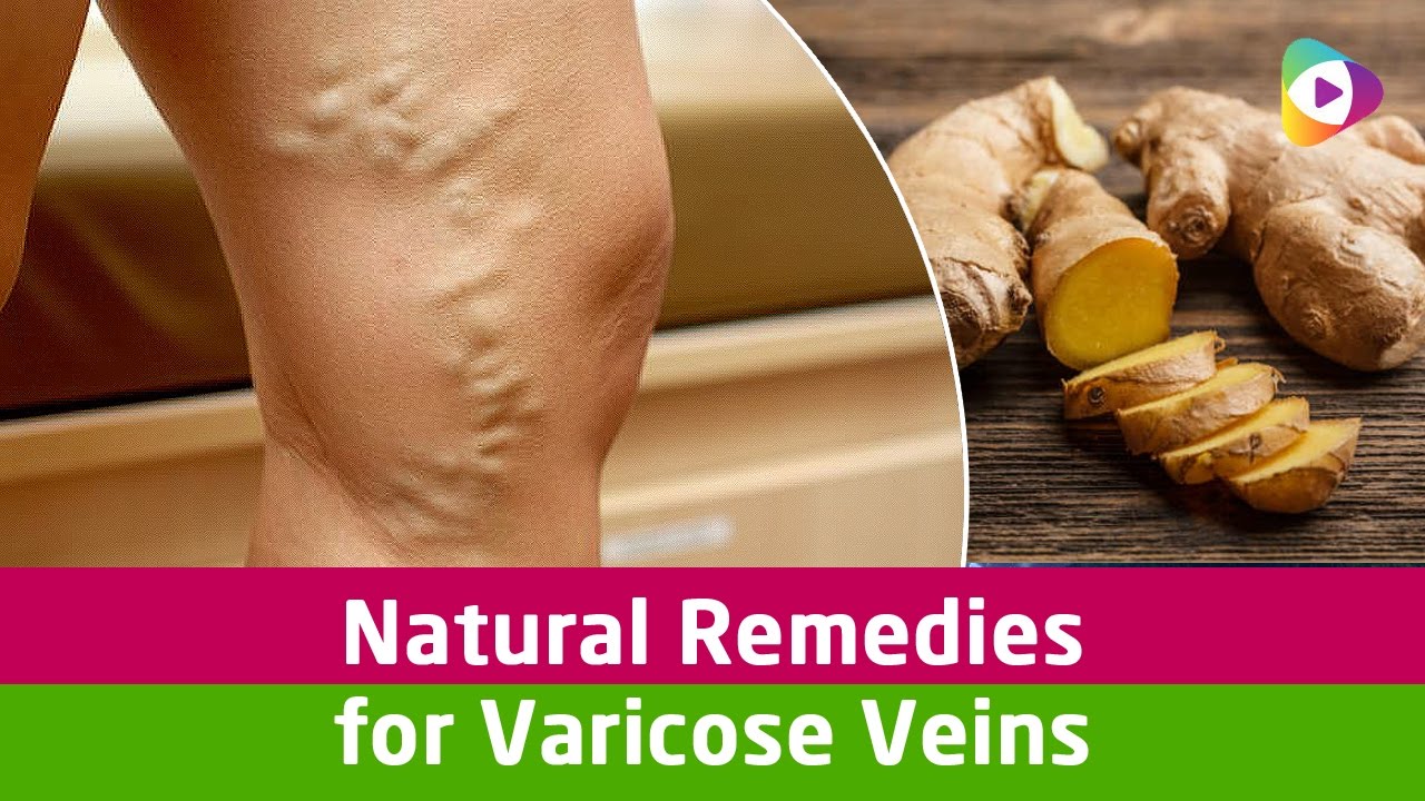 Natural Remedies For Varicose Veins | Vein Treatment - YouTube