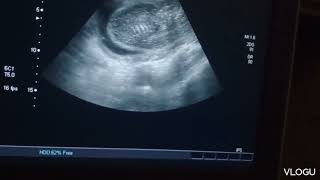 A case of fetal hydrops with skin edema on ultrasound