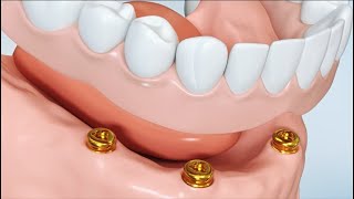 Replacement of all teeth: Removable - Did you know?